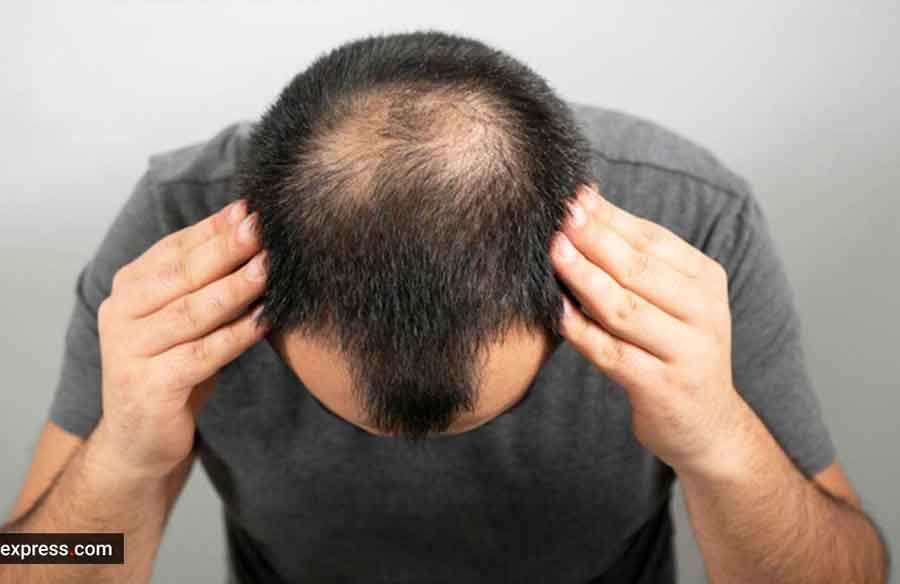 6 Best Treatments for Severe Hair Loss
