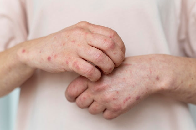 Skin Allergies, Types of Diseases and Proper Treatment Steps