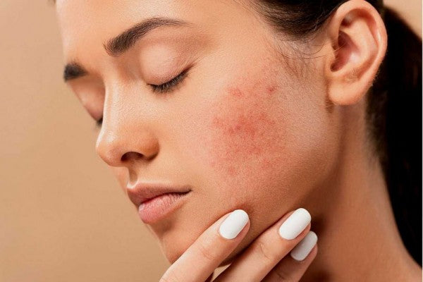 Vitamin A For Acne: Benefits and How To Use