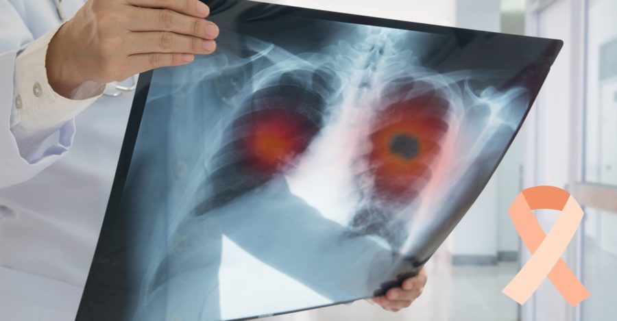 Don't Let Your Guard Down, Recognize the Early Signs and Symptoms of Lung Cancer